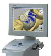 Cerec Porcelain Crowns, Onlays and Veneers